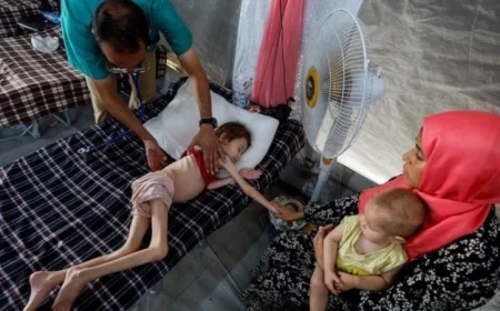 مأساة في غزة: استشهاد 3 فلسطينيين بسبب المجاعة وسوء التغذية في القطاع