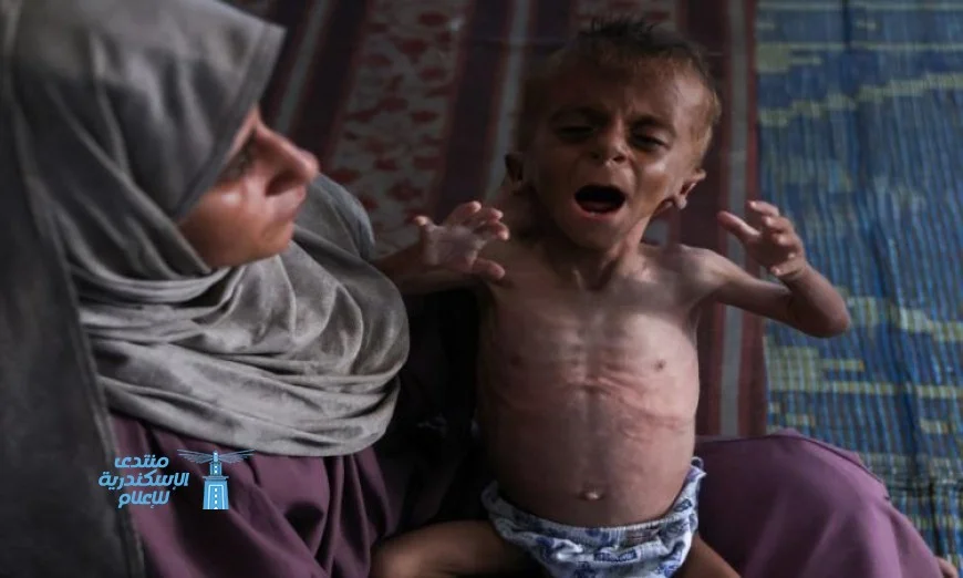 وفاة 11 شخصًا بينهم طفلان بسبب المجاعة وسوء التغذية في غزة خلال يوم واحد