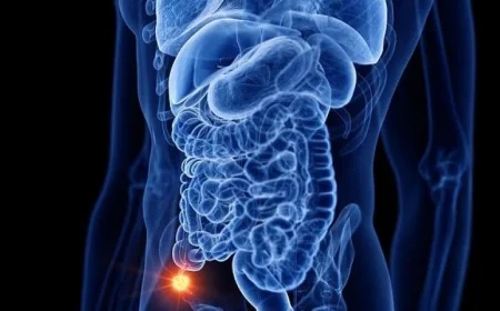تحذيرات من خبراء: تزايد ملحوظ في حالات سرطان الزائدة الدودية بين الشباب