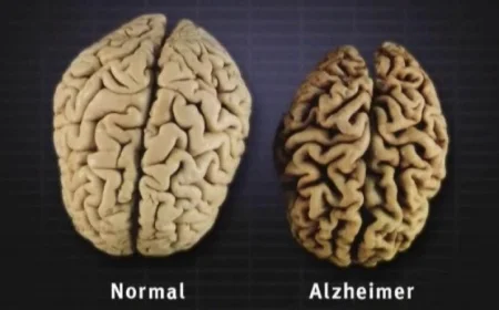 اكتشاف علمي جديد يكشف عن دور الدهون الخفي في تعزيز مرض آلزهايمر