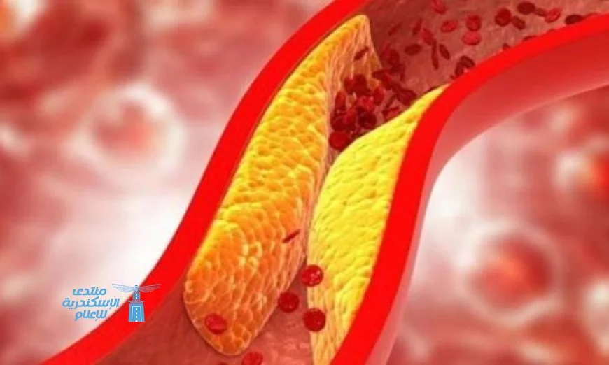 دراسة حديثة توضح العلاقة بين ارتفاع الكوليسترول وزيادة استهلاك السكريات