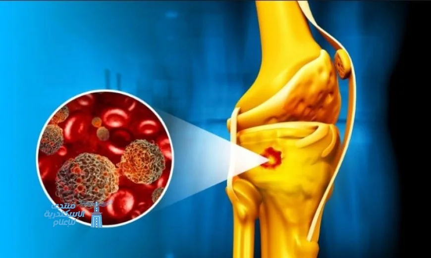 جسيمات نانوية مغناطيسية تكافح سرطان العظام وتعزز الشفاء بشكل فعال