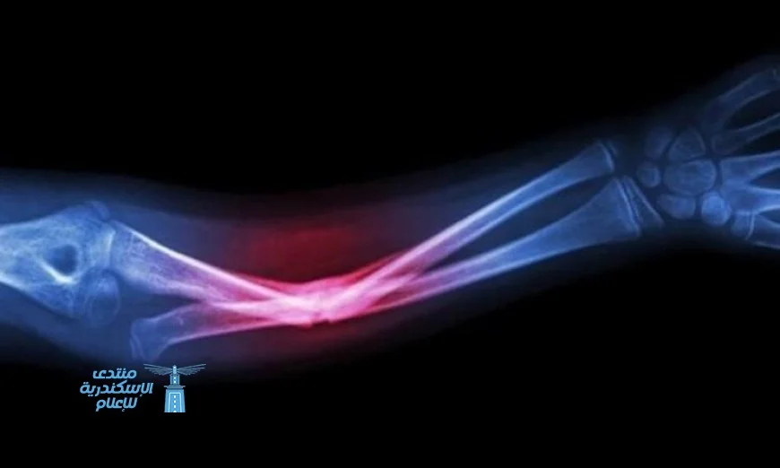 ابتكار جديد يستخدم مخلفات الأسماك لتعزيز نمو العظام بفعالية