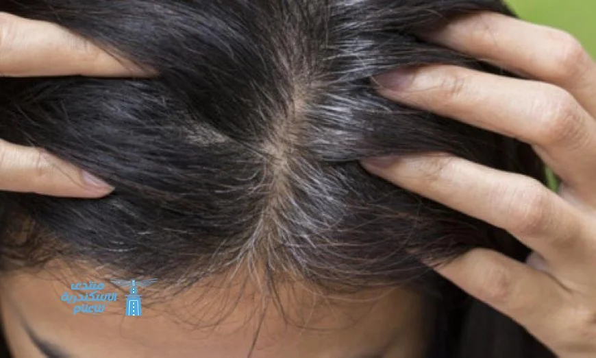 افضل الوصفات الطبيعية للتخلص من قشرة الرأس بشكل فعال