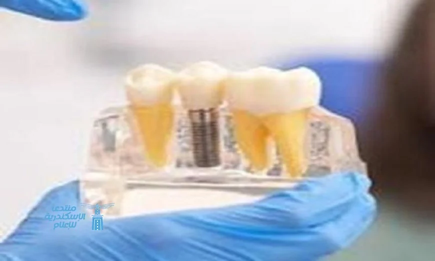 ابتكار مادة حيوية ثورية تعيد تعريف علاج وترميم الأسنان