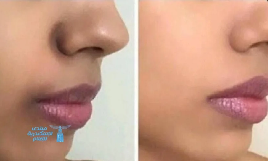 التصبغات حول الفم أسبابها وطرق فعالة لعلاجها طبيعياً وطبيبياً