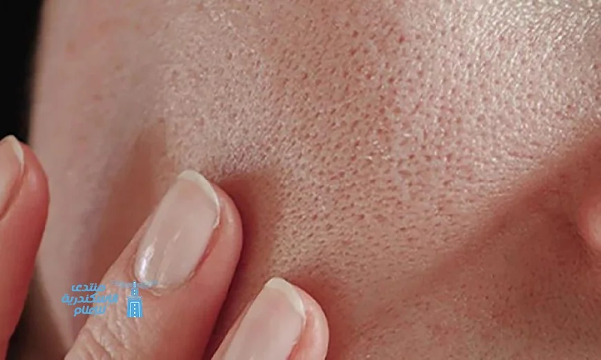 أفضل وصفات طبيعية للتخلص من المسام الواسعة بشكل فعال